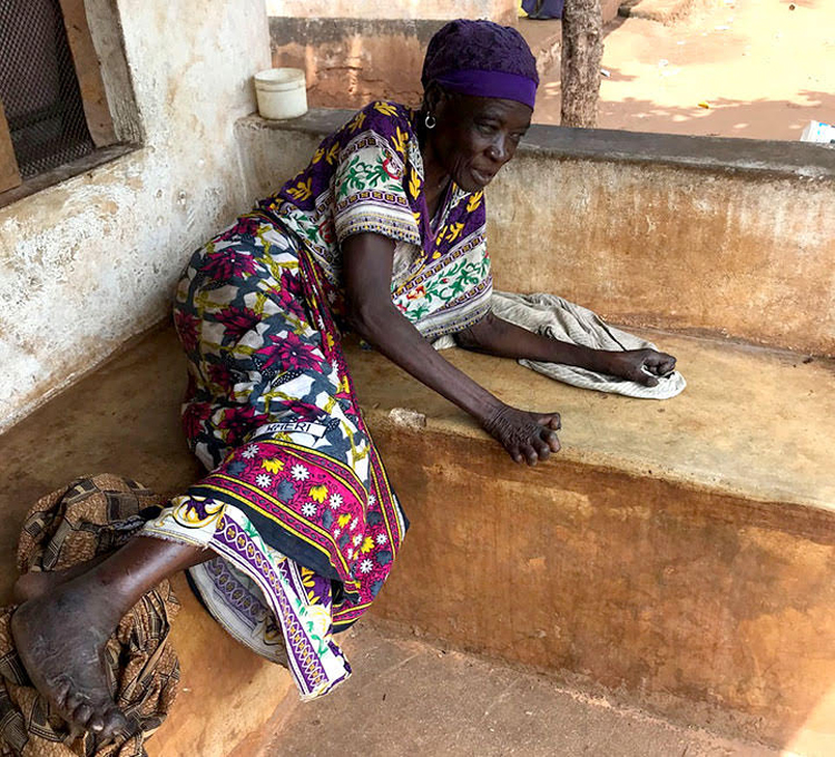 Picture of leprosy-affected victim in Kenya