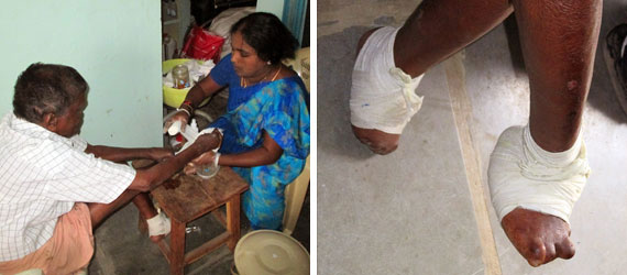 dressing-leprous-wounds-montage