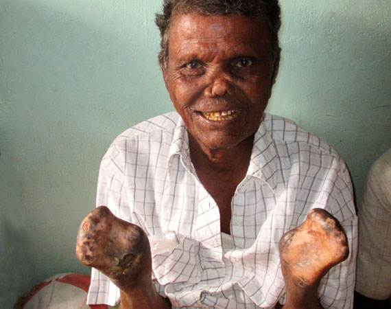 eliah-lost-fingers-to-leprosy