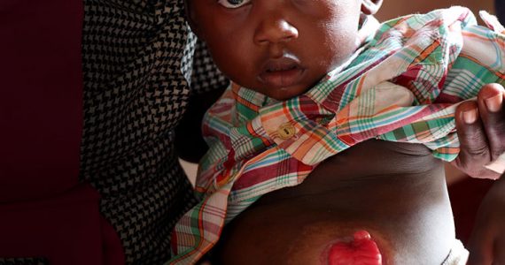 Josephat before the corrective surgery