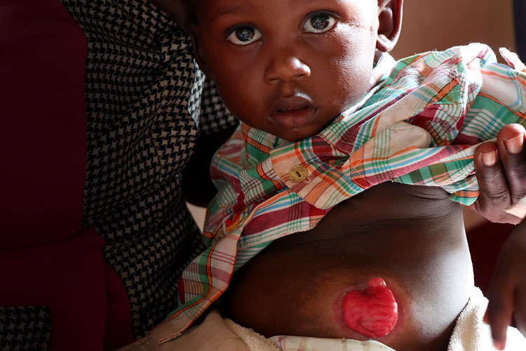 Josephat before the corrective surgery