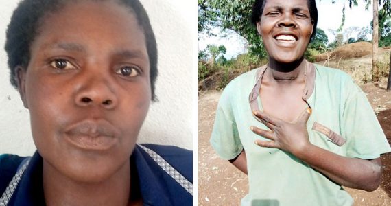 Picture of Alice before and after surgery