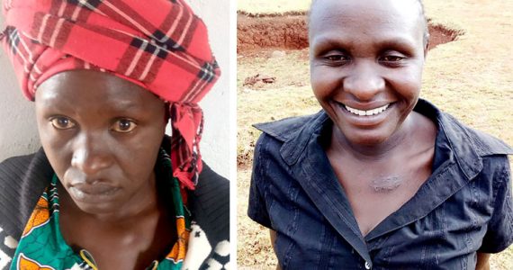 Picture of Carolyne’s before and after surgery