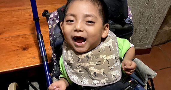 Image of child in Guatemala with medical need smiling