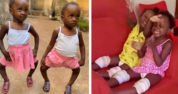 Image of twins after receiving surgery