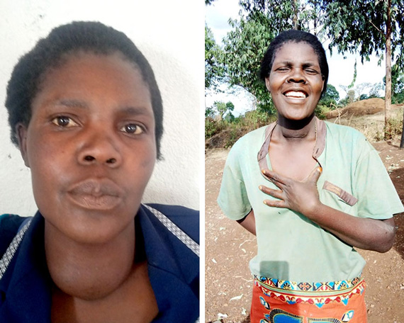 Picture of Alice before and after surgery