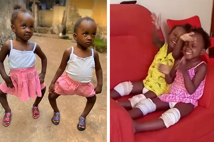 Image of twins before and after surgery