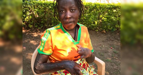 Picture of Ketty, a burn victim in Africa